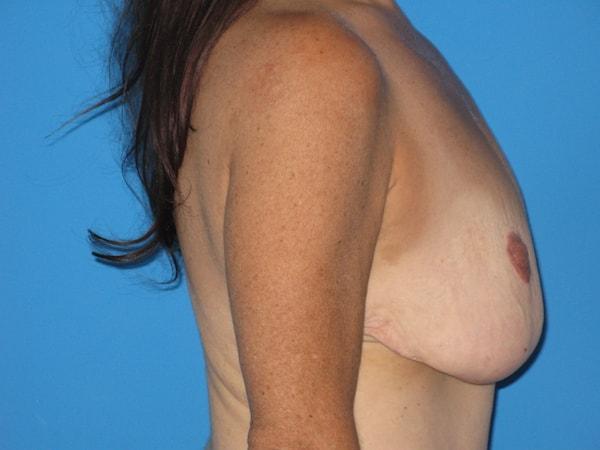Breast Lift before at Plastic Surgeon Baltimore, MD: Dr. Alyson Wells in Cockeysville, MD