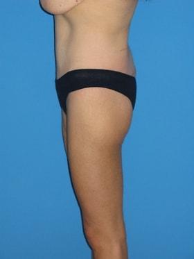 Thigh Lift after at Plastic Surgeon Baltimore, MD: Dr. Alyson Wells in Cockeysville, MD
