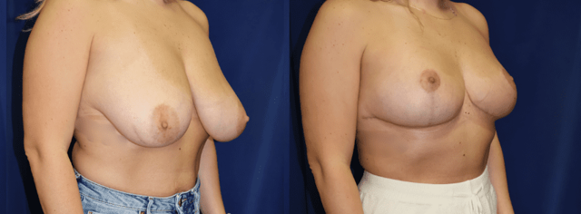 Breast Lift result at Arkansas Plastic Surgery in Little Rock, AR