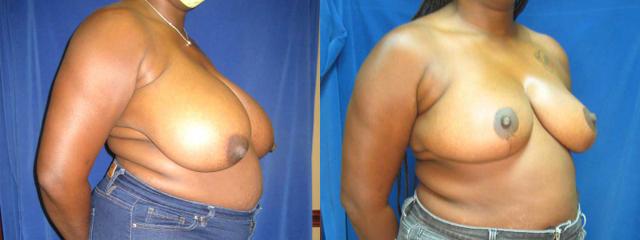 Breast Reduction result at Arkansas Plastic Surgery in Little Rock, AR