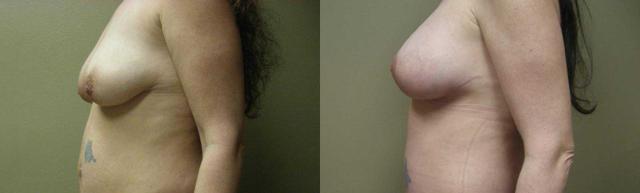 Breast Lift result at Arkansas Plastic Surgery in Little Rock, AR