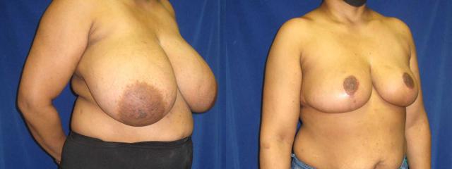 Breast Reduction result at Arkansas Plastic Surgery in Little Rock, AR