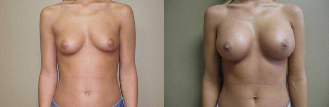 Breast Augmentation result at Arkansas Plastic Surgery in Little Rock, AR
