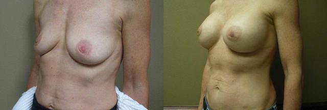 Breast Augmentation result at Arkansas Plastic Surgery in Little Rock, AR