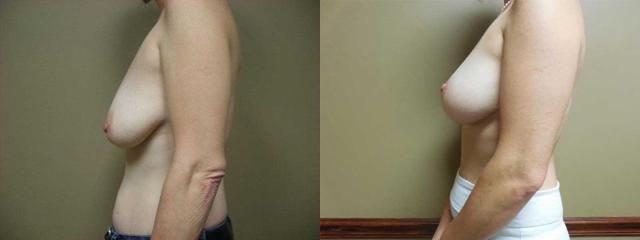 Breast Lift result at Arkansas Plastic Surgery in Little Rock, AR