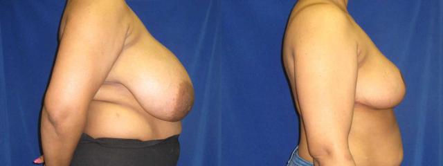 Breast Reduction result at Arkansas Plastic Surgery in Little Rock, AR