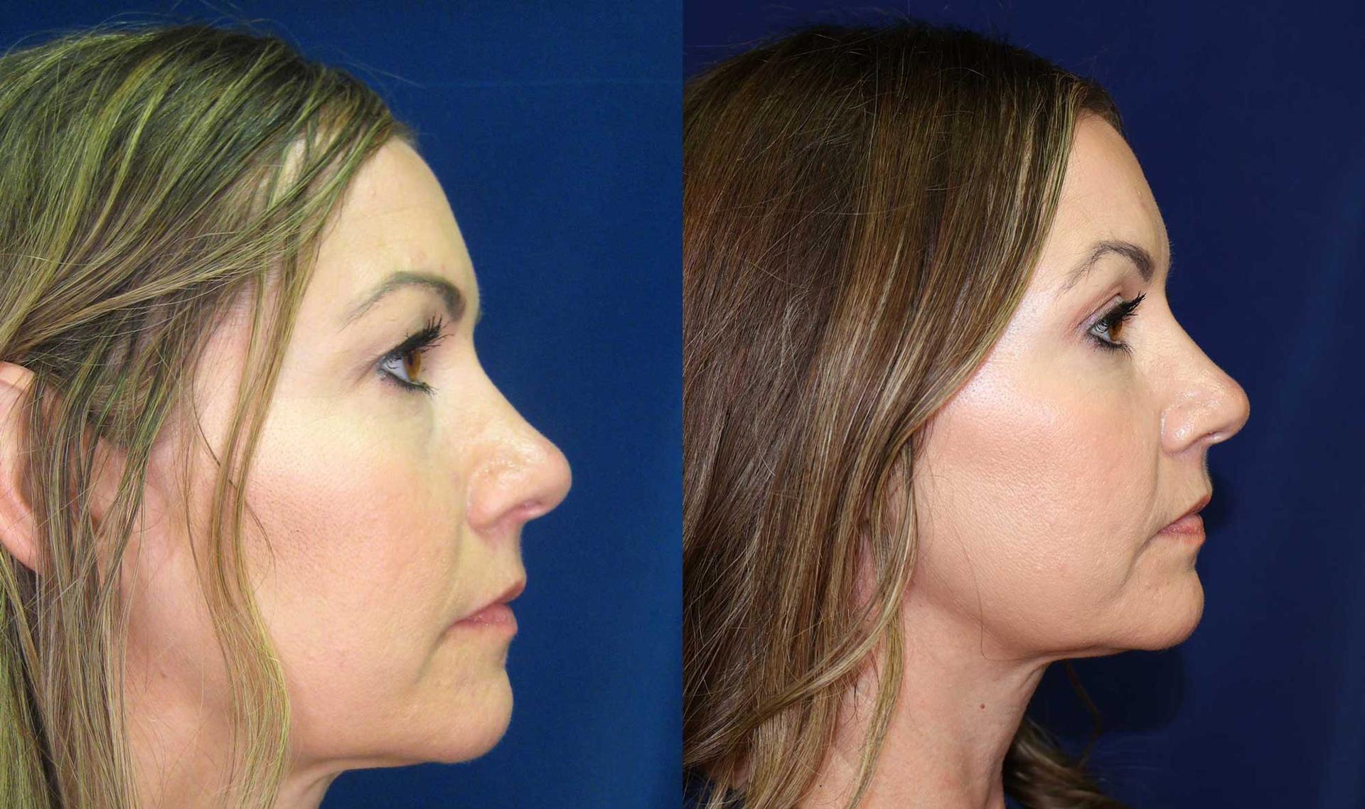 Arkansas Plastic Surgery blepharoplasty result — Little Rock, AR