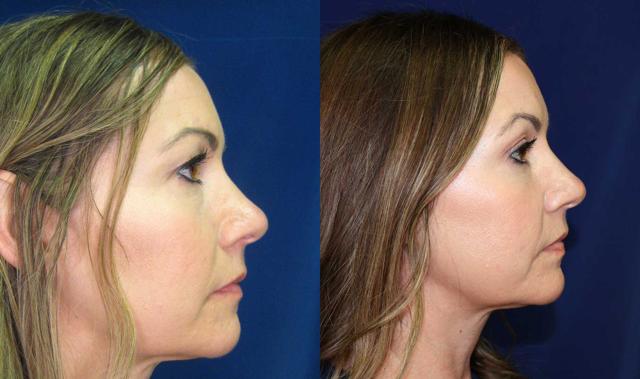 Blepharoplasty result at Arkansas Plastic Surgery in Little Rock, AR