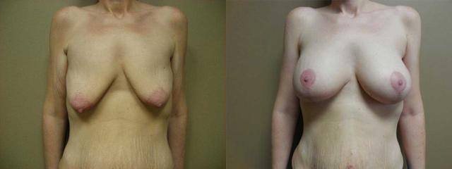 Breast Lift result at Arkansas Plastic Surgery in Little Rock, AR