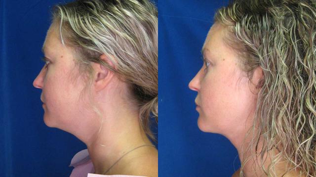 Liquid BBL result at Arkansas Plastic Surgery in Little Rock, AR