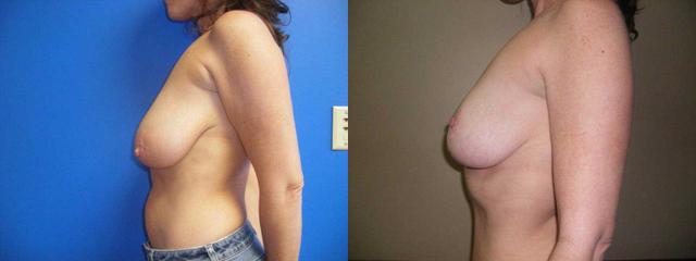 Mini Tummy Tuck result at Arkansas Plastic Surgery in Little Rock, AR
