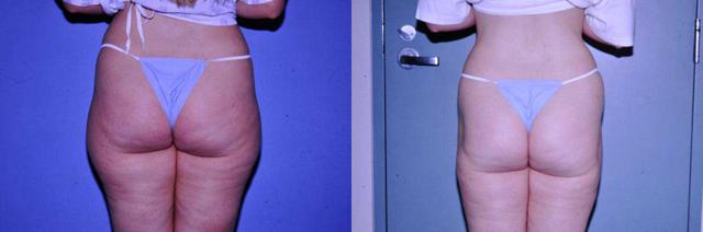 Liquid BBL result at Arkansas Plastic Surgery in Little Rock, AR
