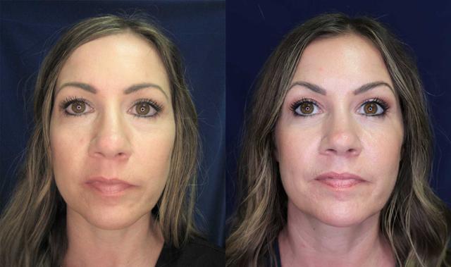 Blepharoplasty result at Arkansas Plastic Surgery in Little Rock, AR