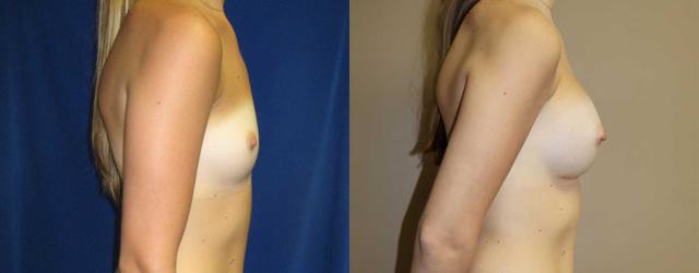 Breast Reduction result at Arkansas Plastic Surgery in Little Rock, AR