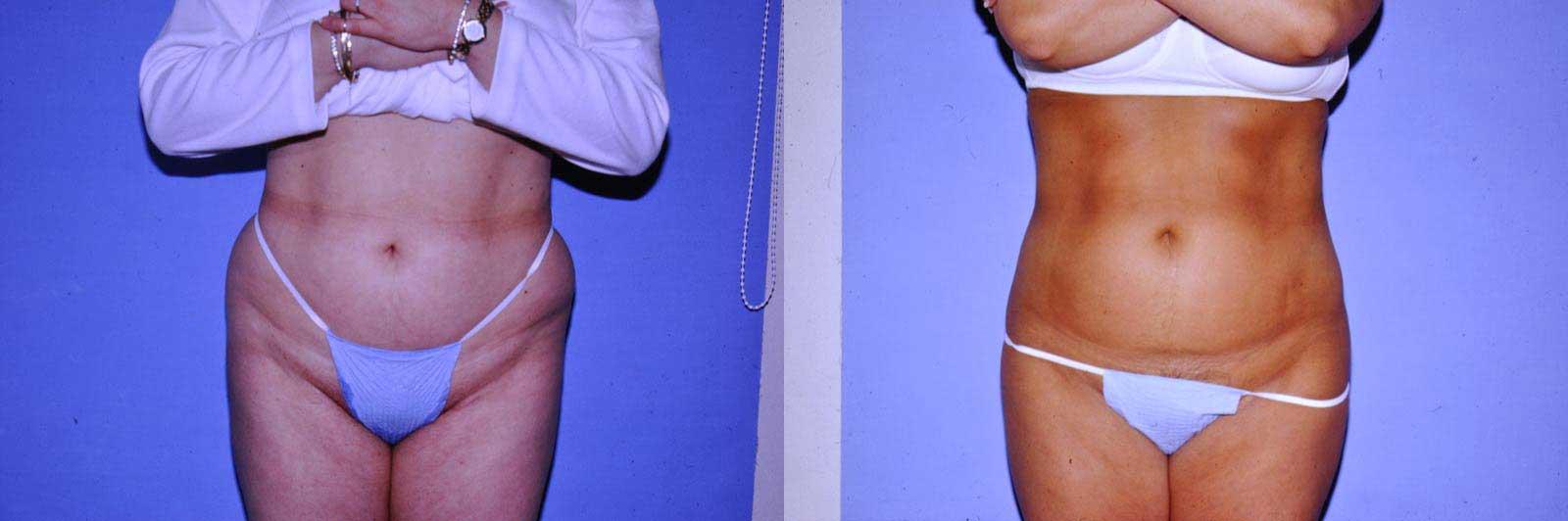 Arkansas Plastic Surgery liposuction result — Little Rock, AR