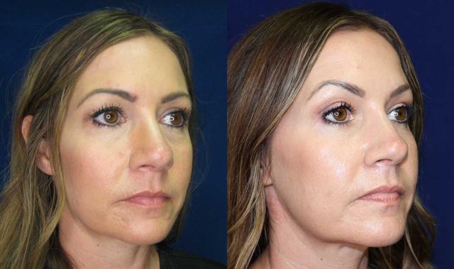 Blepharoplasty result at Arkansas Plastic Surgery in Little Rock, AR