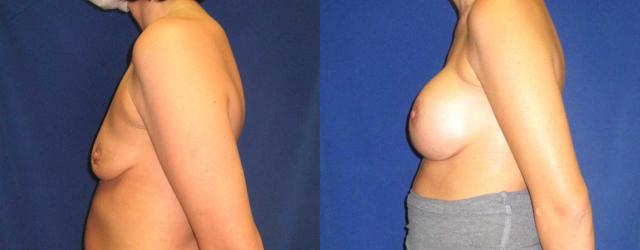Fat Transfer Breast Augmentation result at Arkansas Plastic Surgery in Little Rock, AR
