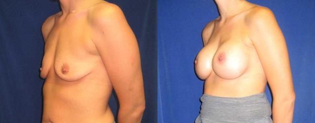Fat Transfer Breast Augmentation result at Arkansas Plastic Surgery in Little Rock, AR