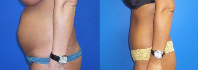 Mini Tummy Tuck result at Arkansas Plastic Surgery in Little Rock, AR