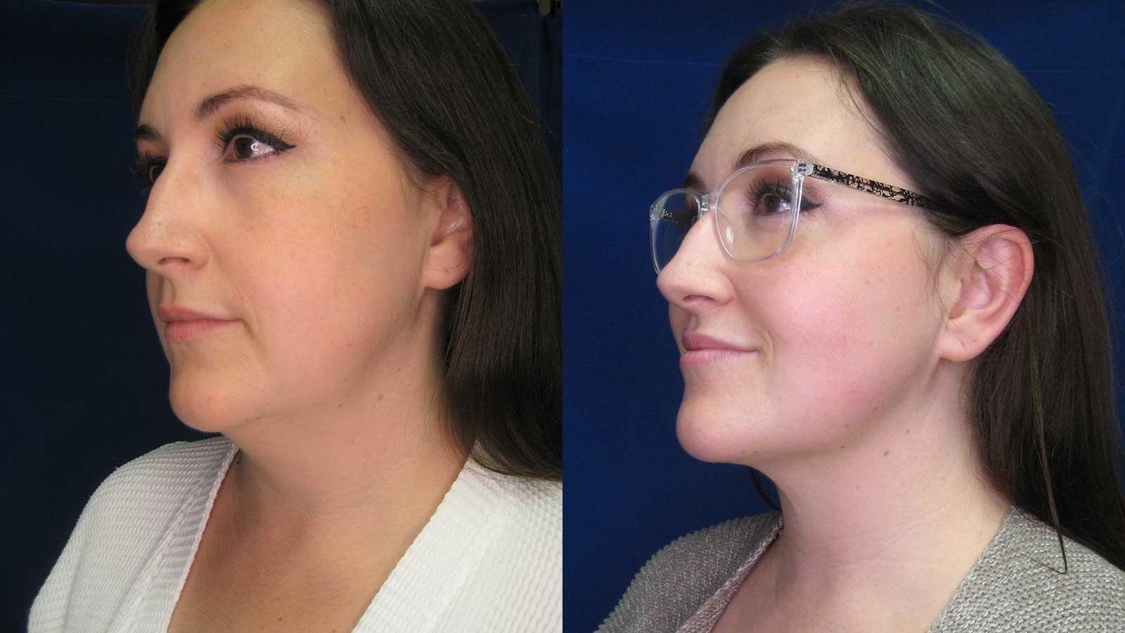 Arkansas Plastic Surgery liposuction result — Little Rock, AR