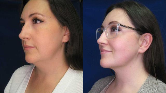 Liquid BBL result at Arkansas Plastic Surgery in Little Rock, AR