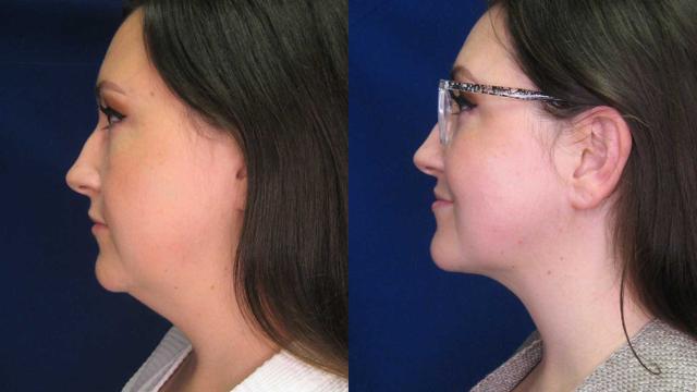 Liquid BBL result at Arkansas Plastic Surgery in Little Rock, AR
