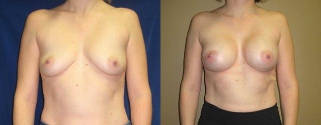 Fat Transfer Breast Augmentation result at Arkansas Plastic Surgery in Little Rock, AR