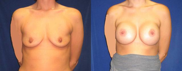 Fat Transfer Breast Augmentation result at Arkansas Plastic Surgery in Little Rock, AR