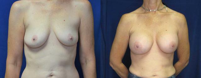 Fat Transfer Breast Augmentation result at Arkansas Plastic Surgery in Little Rock, AR