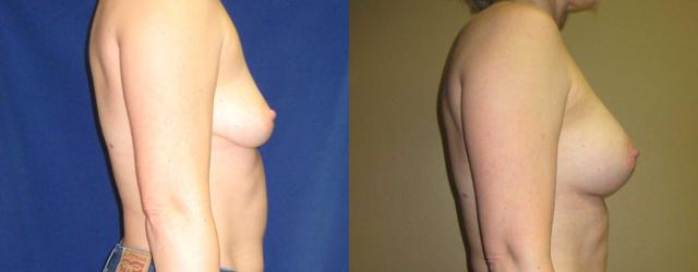 Fat Transfer Breast Augmentation result at Arkansas Plastic Surgery in Little Rock, AR