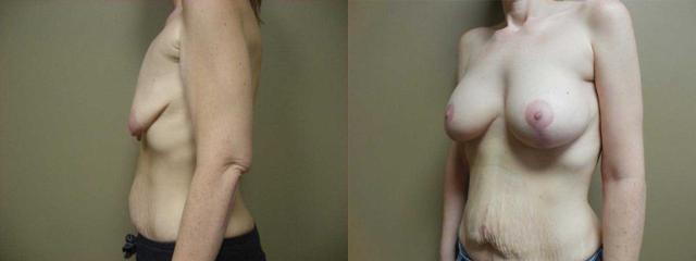 Breast Augmentation result at Arkansas Plastic Surgery in Little Rock, AR
