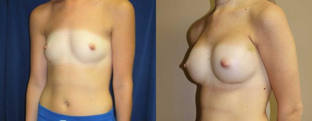 Breast Reduction result at Arkansas Plastic Surgery in Little Rock, AR