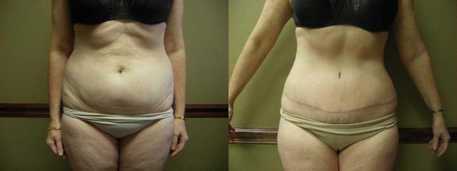 Mini Tummy Tuck result at Arkansas Plastic Surgery in Little Rock, AR