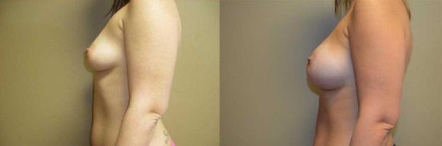 Breast Augmentation result at Arkansas Plastic Surgery in Little Rock, AR