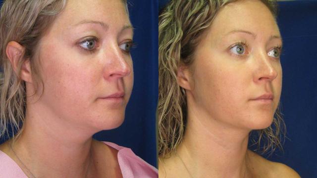 Liquid BBL result at Arkansas Plastic Surgery in Little Rock, AR