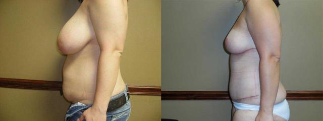 Mini Tummy Tuck result at Arkansas Plastic Surgery in Little Rock, AR