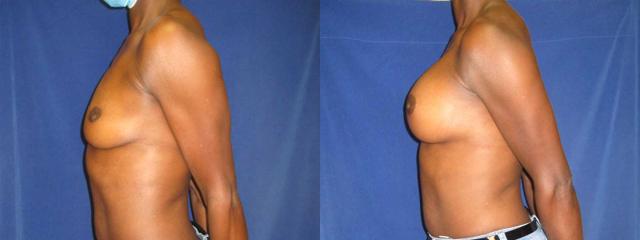 Fat Transfer Breast Augmentation result at Arkansas Plastic Surgery in Little Rock, AR