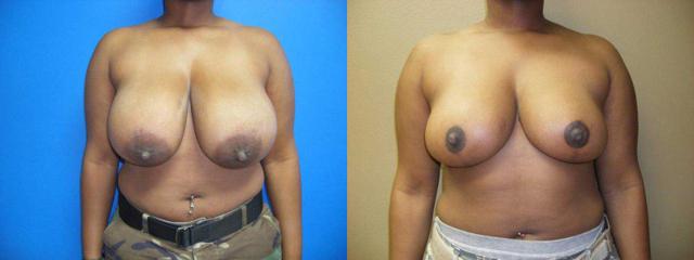 Breast Reduction result at Arkansas Plastic Surgery in Little Rock, AR