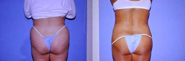 Liquid BBL result at Arkansas Plastic Surgery in Little Rock, AR