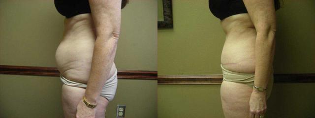 Mini Tummy Tuck result at Arkansas Plastic Surgery in Little Rock, AR