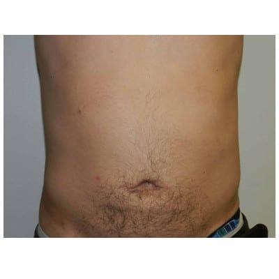 David Altamira, MD liposuction after — Houston, TX