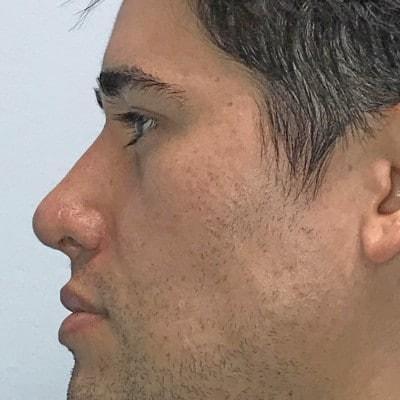 David Altamira, MD rhinoplasty after — Houston, TX