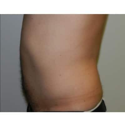 David Altamira, MD liposuction after — Houston, TX
