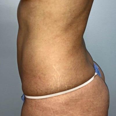 David Altamira, MD liposuction after — Houston, TX