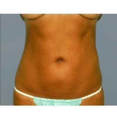 David Altamira, MD liposuction after — Houston, TX