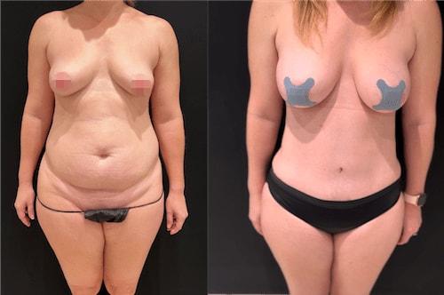 Mommy Makeover result at Neinstein Plastic Surgery in New York, NY