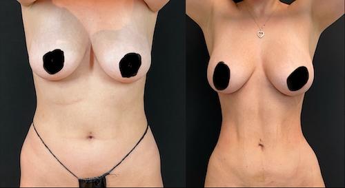 Liposuction result at Neinstein Plastic Surgery in New York, NY