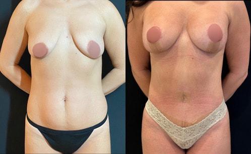 Breast Lift result at Neinstein Plastic Surgery in New York, NY