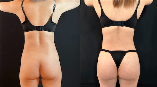 Brazilian Butt Lift result at Neinstein Plastic Surgery in New York, NY