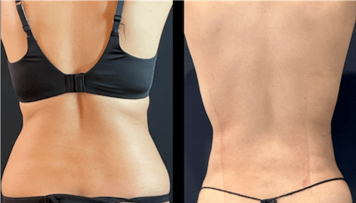 Neinstein Plastic Surgery liposuction result — New York, NY